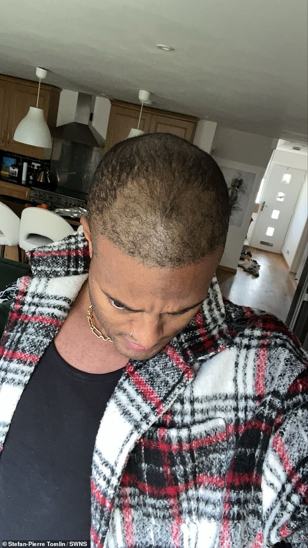 Mr Tinder' Reveals His 14-Year Secret: The Hair Transplant That Exposed His Baldness