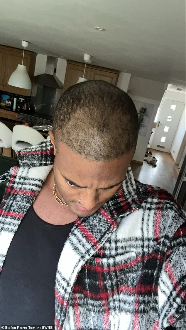 Mr Tinder' Reveals His 14-Year Secret: The Hair Transplant That Exposed His Baldness