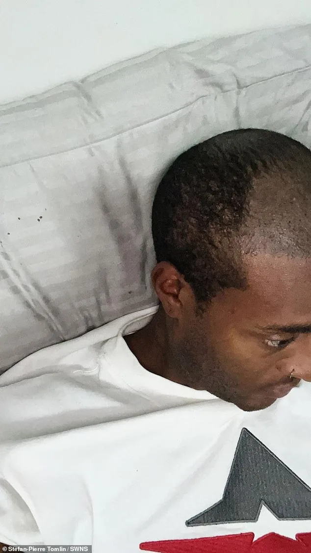 Mr Tinder' Reveals His 14-Year Secret: The Hair Transplant That Exposed His Baldness