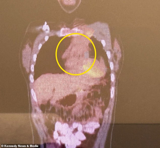 From Overlooked Rashes to Severe Skin Condition: How a College Student's Neglected Symptoms Led to a Medical Emergency