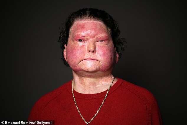 Joseph DiMeo Survives Drowsy Driving Crash and 80% Burn Injuries, Embarking on Reconstructive Surgery Journey