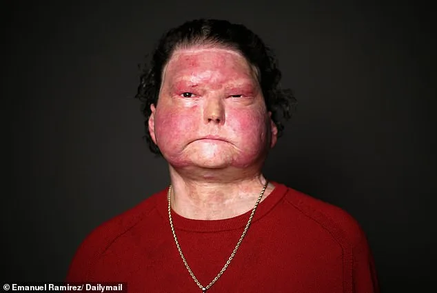 Joseph DiMeo Survives Drowsy Driving Crash and 80% Burn Injuries, Embarking on Reconstructive Surgery Journey