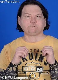 Joseph DiMeo Survives Drowsy Driving Crash and 80% Burn Injuries, Embarking on Reconstructive Surgery Journey