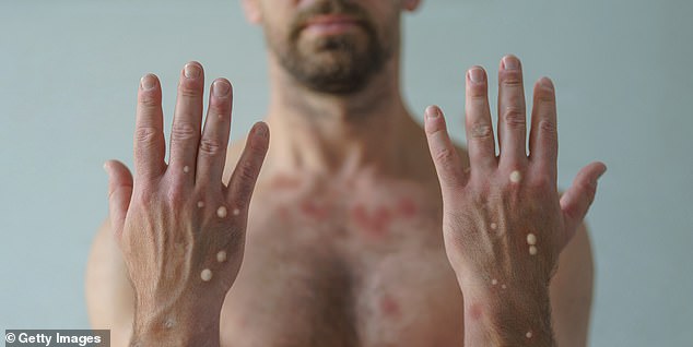 New York Confirms First Local Case of More Severe Clade I Mpox