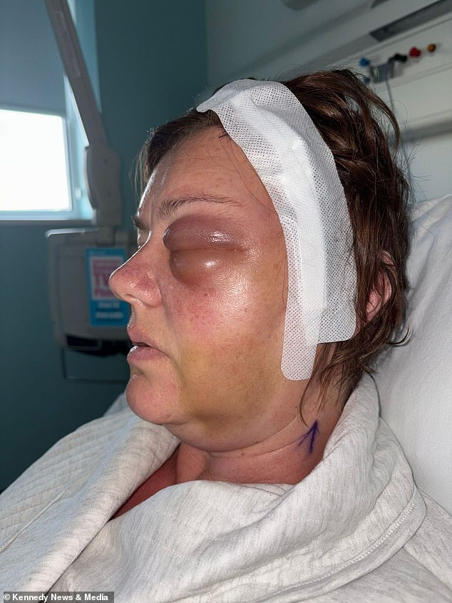 Delayed Diagnosis Reveals Golf-Ball-Sized Tumor in Woman's Eye After Years of Ignored Symptoms
