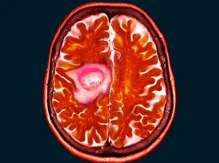 Delayed Diagnosis Reveals Golf-Ball-Sized Tumor in Woman's Eye After Years of Ignored Symptoms