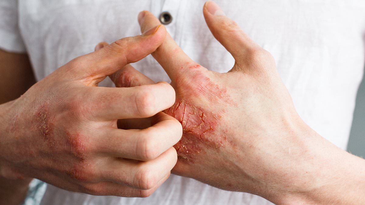 FDA Approves Groundbreaking Oral Pill Icotyde for Psoriasis, Offering New Hope for Millions
