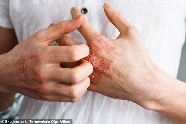 FDA Approves Groundbreaking Oral Pill Icotyde for Psoriasis, Offering New Hope for Millions