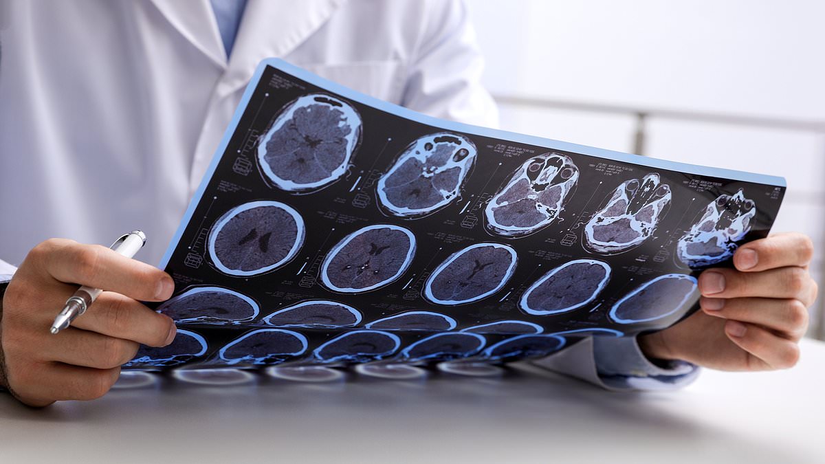 Rising MS Cases in England Linked to Smoking, Obesity, and Socioeconomic Deprivation, Study Reveals