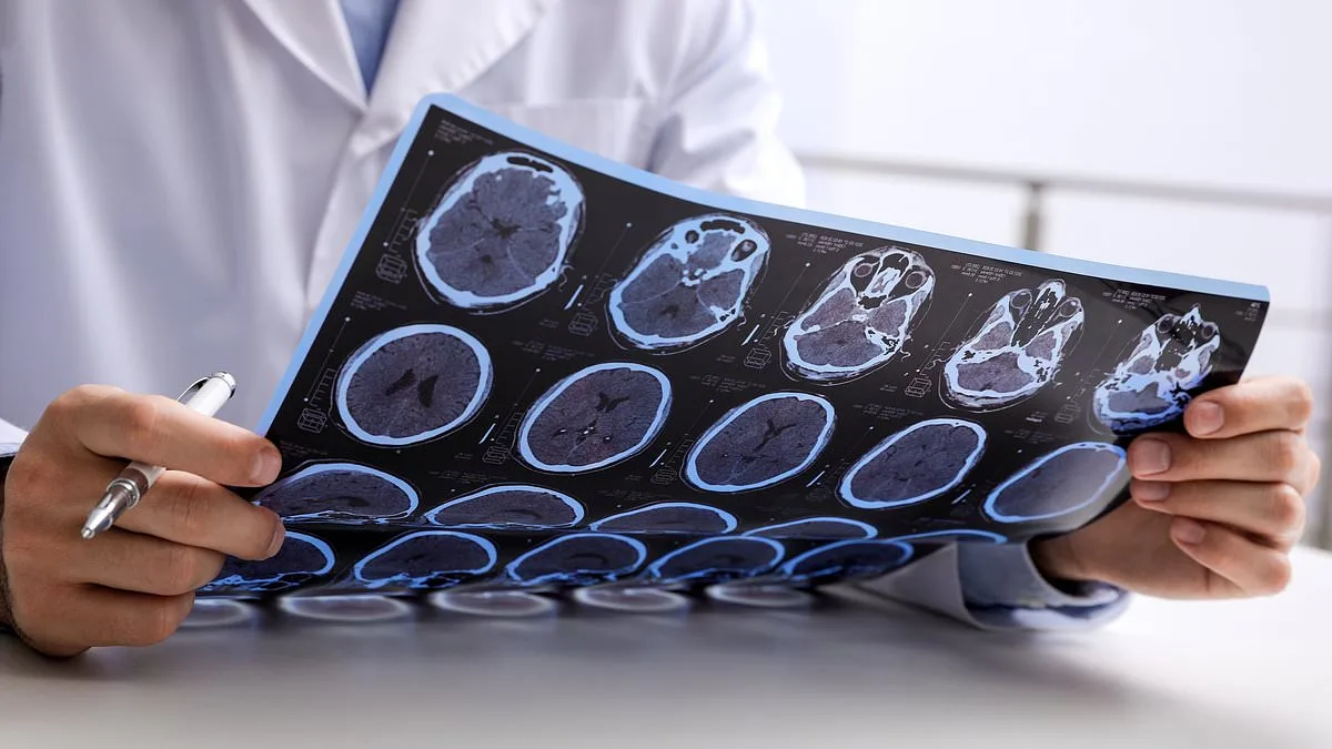 Rising MS Cases in England Linked to Smoking, Obesity, and Socioeconomic Deprivation, Study Reveals