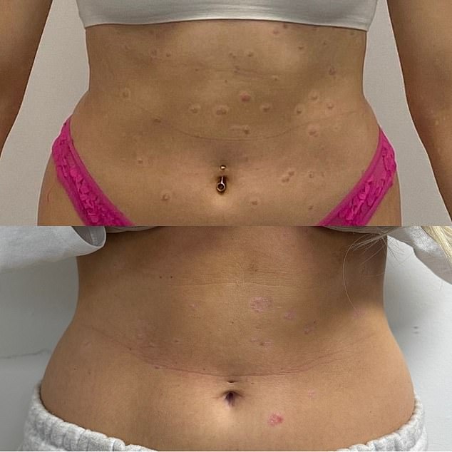 A 14-Year Battle with Psoriasis: Shannon Higham's Relentless Fight Against an Autoimmune Disease