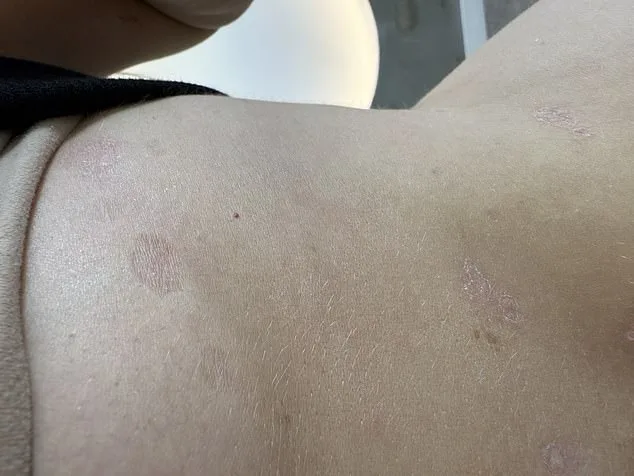A 14-Year Battle with Psoriasis: Shannon Higham's Relentless Fight Against an Autoimmune Disease