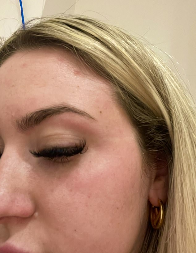 A 14-Year Battle with Psoriasis: Shannon Higham's Relentless Fight Against an Autoimmune Disease