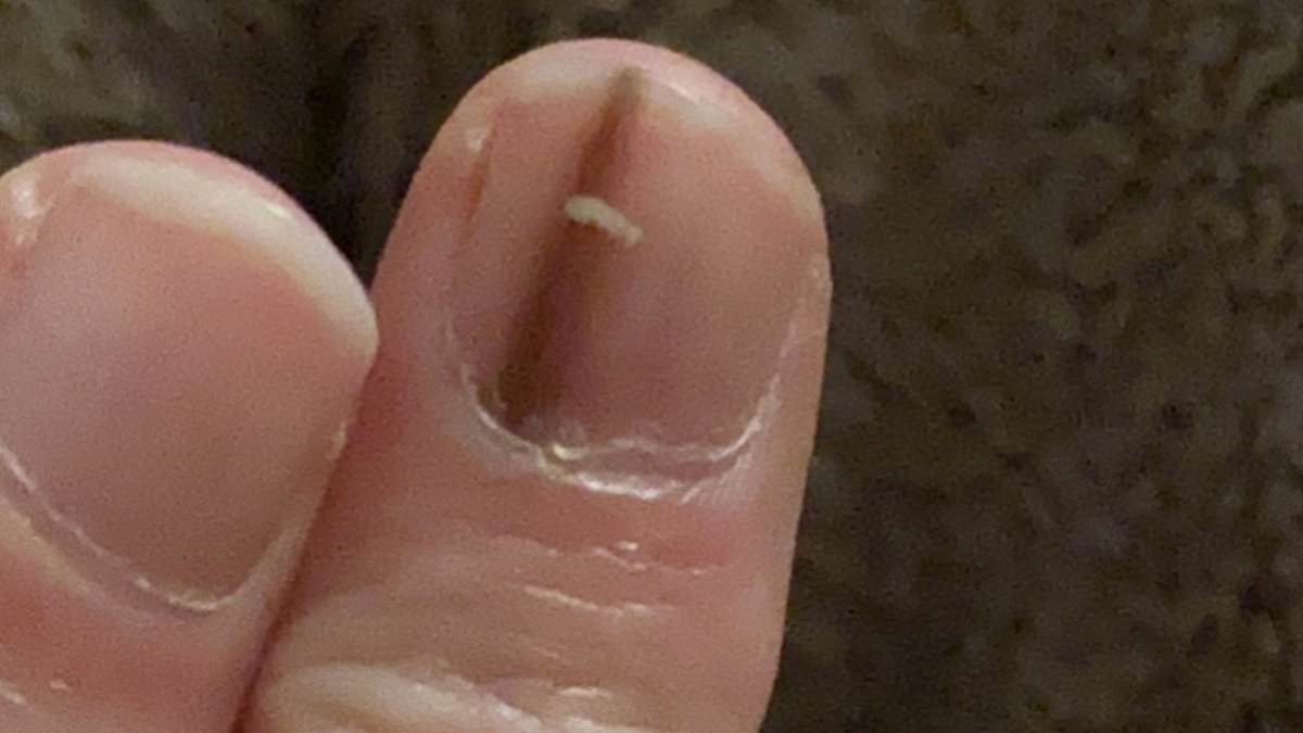 From Fingernail Mark to Amputation: The Story of a Misdiagnosed Skin Cancer