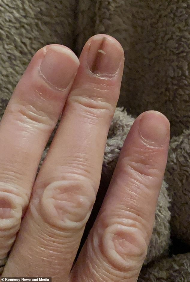 From Fingernail Mark to Amputation: The Story of a Misdiagnosed Skin Cancer
