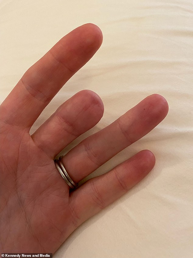 From Fingernail Mark to Amputation: The Story of a Misdiagnosed Skin Cancer