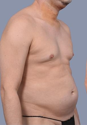 From Stubborn Fat to Sculpted Abs: Frank Hoyle's $23,000 Liposuction Miracle