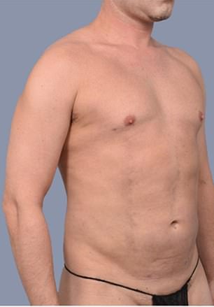 From Stubborn Fat to Sculpted Abs: Frank Hoyle's $23,000 Liposuction Miracle