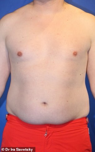 From Stubborn Fat to Sculpted Abs: Frank Hoyle's $23,000 Liposuction Miracle