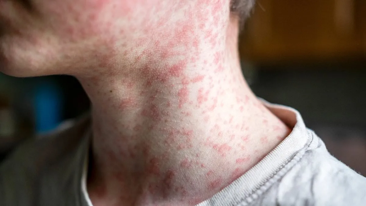 Measles Exposure at O'Hare Airport Raises Concerns as Unvaccinated Individual Visits Local Stores