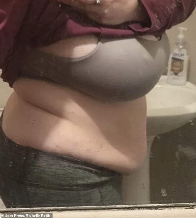 Michelle Keith's Postpartum Struggle with Lipoedema: A Chronic, Incurable Battle