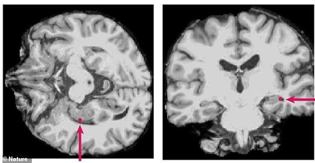 Baylor Study Reveals Active Brain Processing Under General Anesthesia