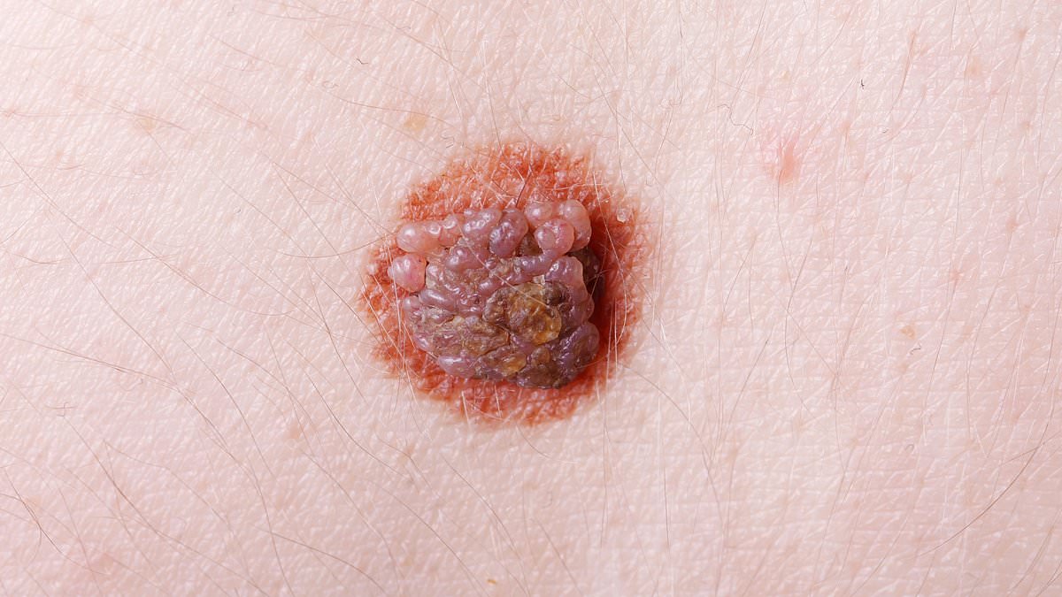Global skin cancer cases projected to surge by 2050 as melanoma becomes major killer