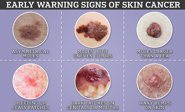 Global skin cancer cases projected to surge by 2050 as melanoma becomes major killer