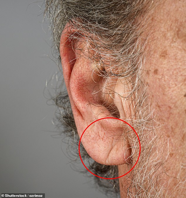 Earlobe creases may signal high risk of fatal heart disease.