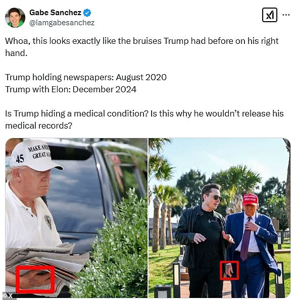 Trump Hand Bruise Sparks Online Speculation: Is It a Concern?