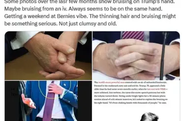 Trump's Hand Bruise: Public Concern, Expert Advice