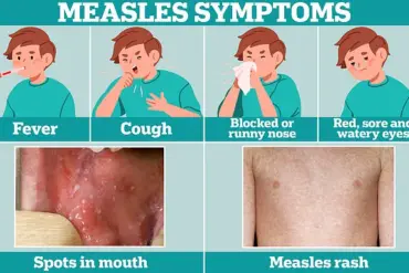 Measles Case Reported in Washington D.C.; Health Officials Warn of Possible Exposure Sites