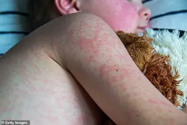 Measles Cases Surge in First Three Months of 2024, Exceeding Total for All of 2023