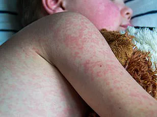 Measles Strikes Vaccinated Teacher: Urgent Warning About Disease's Severity