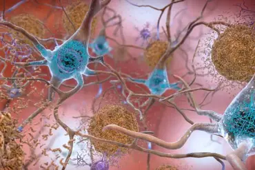 New Study Uncovers Potential Reason Behind Women's Higher Risk of Alzheimer's