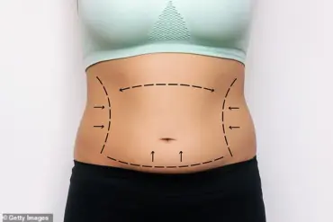 Exclusive Surge in Thigh Lift Surgeries Driven by Ozempic-Induced Weight Loss