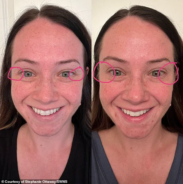 A Mother's Regret: 'One of the Most Devastating Mistakes of My Life' After Botox-Like Injections