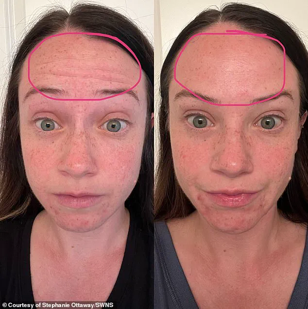 A Mother's Regret: 'One of the Most Devastating Mistakes of My Life' After Botox-Like Injections