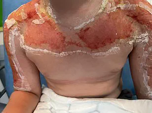 Exclusive: Sunburn's Hidden Peril Revealed in Dominican Republic Medical Emergency