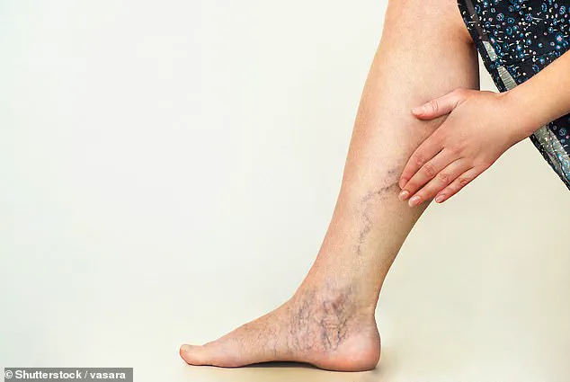Study Links Varicose Veins to Increased Dementia Risk, Prompting Calls for Public Health Awareness