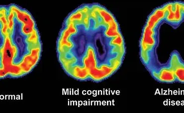 The Hidden Dangers of Memory Loss: How Everyday Forgetfulness Can Threaten Families and Communities