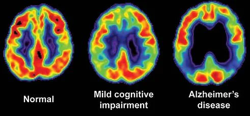 The Hidden Dangers of Memory Loss: How Everyday Forgetfulness Can Threaten Families and Communities