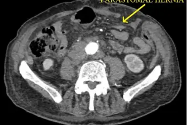 Rare Post-Hernia Repair Complication: Spontaneous Evisceration in Elderly Patient Sparks Medical Inquiry