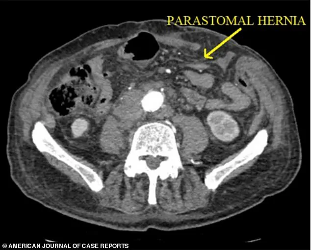 Rare Post-Hernia Repair Complication: Spontaneous Evisceration in Elderly Patient Sparks Medical Inquiry