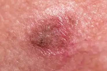 Understanding Skin Health: A Guide to Recognizing and Addressing Common Dermatological Concerns
