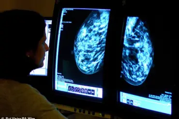 Urgent NHS Expansion: Breast Cancer Screening to Begin for Women in Their 30s to Close Diagnostic Gap
