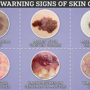 Melanoma's Elusive Signs: Exclusive Insights from GPs on Detecting Hidden Dangers