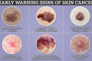Melanoma's Elusive Signs: Exclusive Insights from GPs on Detecting Hidden Dangers