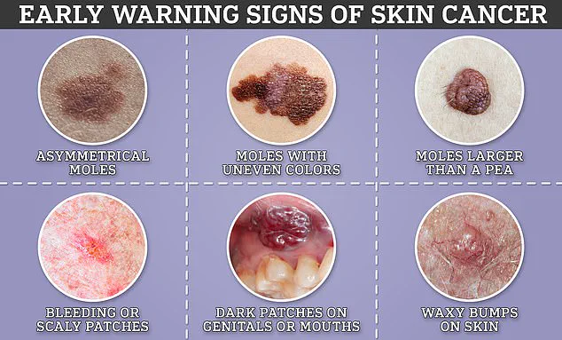 Melanoma's Elusive Signs: Exclusive Insights from GPs on Detecting Hidden Dangers