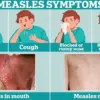 Public Health Alert: Declining MMR Vaccination Rates in the UK Raise Concerns of Measles Resurgence Amid Tragic Child Death in Liverpool